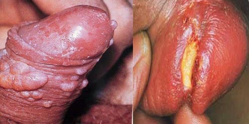 cara mengobati sipilis dengan lidah buaya