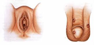 Obat Sipilis Yg Bagus