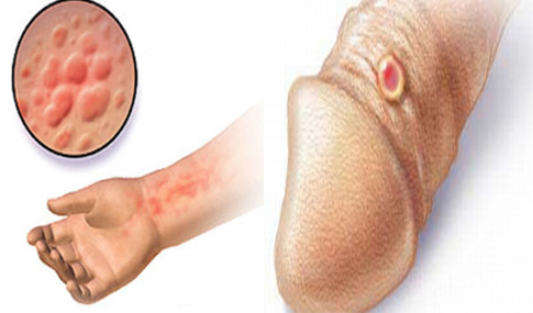 Obat Sipilis Buat Sendiri